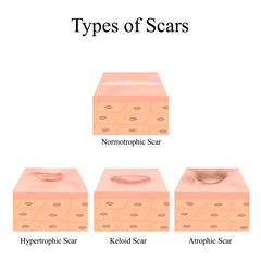 Types of acne scars